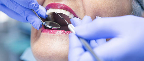 Best Teeth Whitening  in Henderson, GA